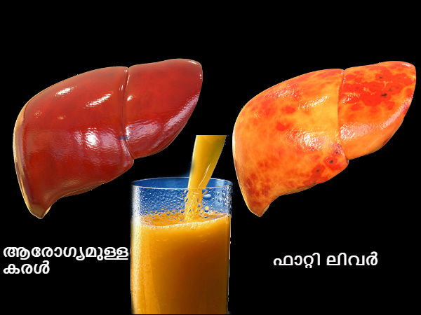  ഫാറ്റി ലിവറിന് പരിഹാരം