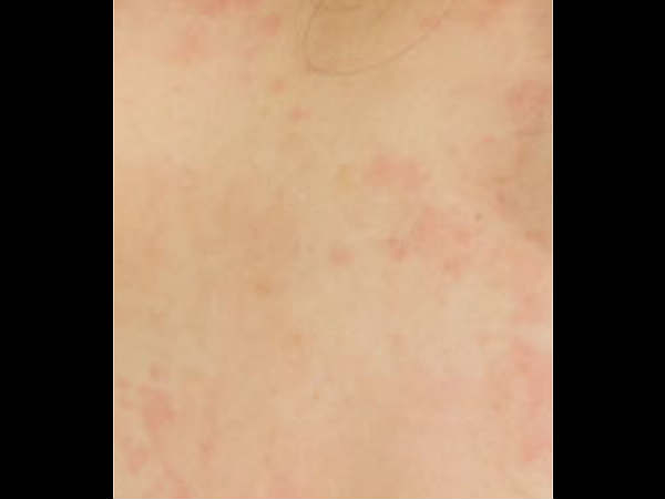 ചര്‍മത്തില്‍ ഇത്തരം കുരുക്കളോ, എങ്കില്‍