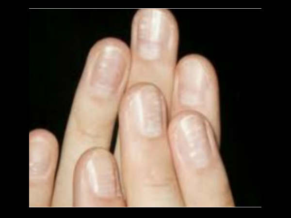 നഖത്തിലെ വെളുത്ത കുത്തുകള് നഖത്തിലെ വെളുത്ത കുത്തുകള്