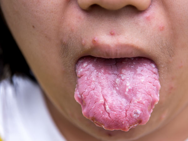 നാവിലെ മുറിവ്