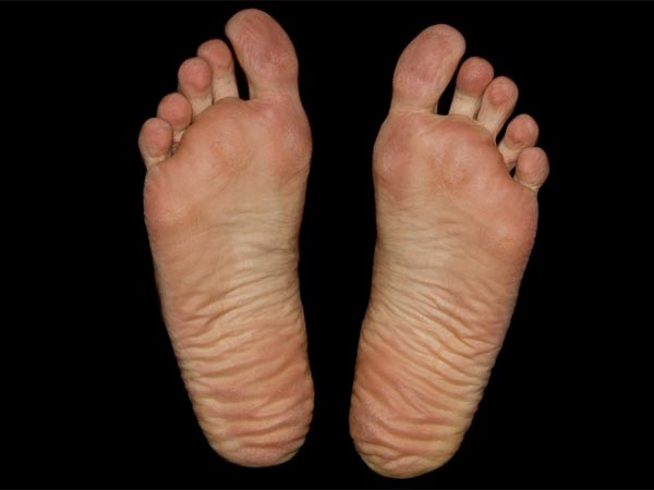 കാലിലെ ആണി