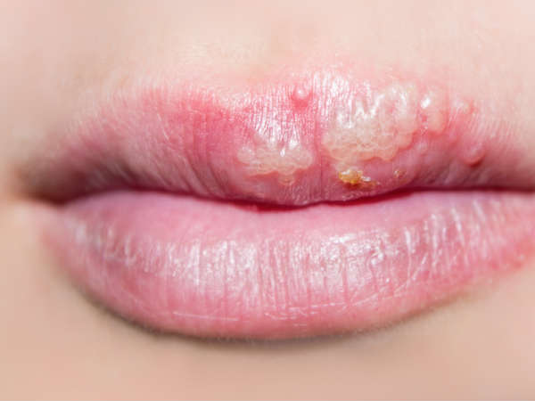  ചുണ്ടിലെ വ്രണം