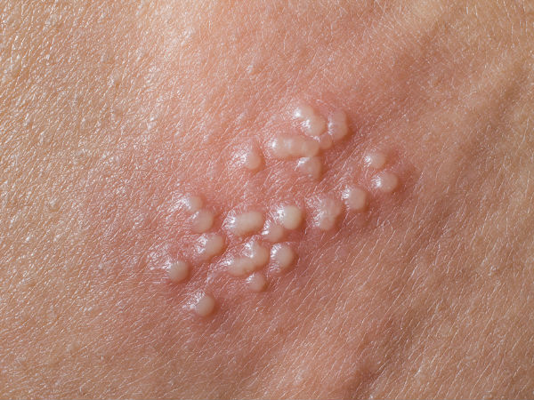 ശരീരത്തില്‍ കാണപ്പെടുന്ന കുരുക്കള്‍