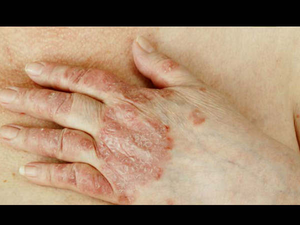  സവാള നീര്