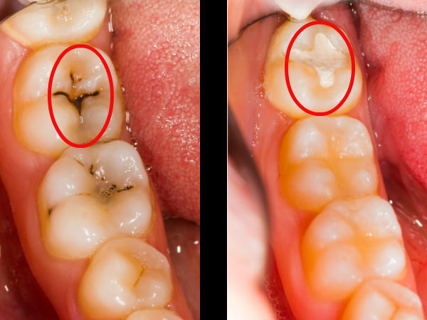 വിറ്റാമിന്‍ ഡി