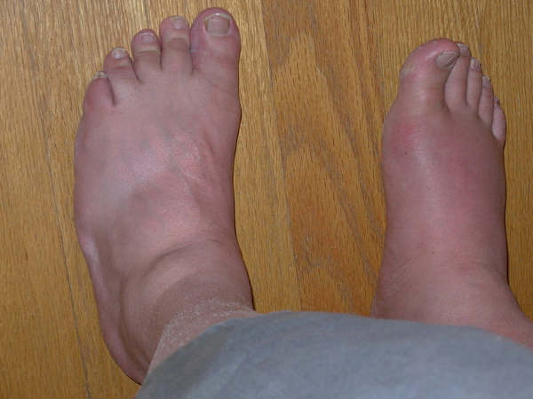 അക്യൂട്ട് ബ്രോങ്കൈറ്റിസ്: ലക്ഷണങ്ങൾ, കാരണങ്ങൾ, ചികിത്സ, കൂടുതൽ