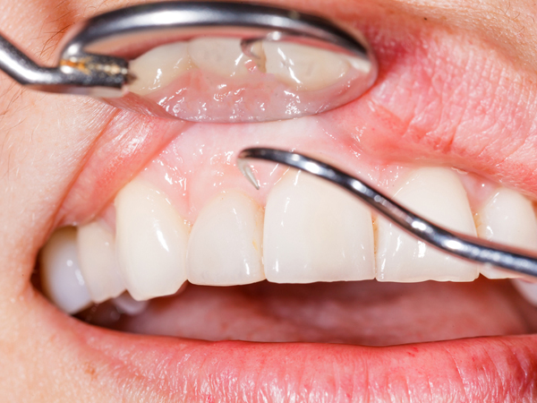 പല പോഷകങ്ങളുടേയും കുറവ്