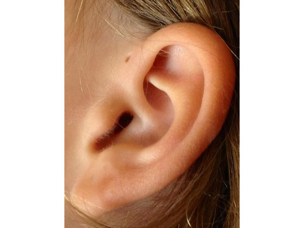  ചെവിക്കടുത്തുള്ള ദ്വാരം