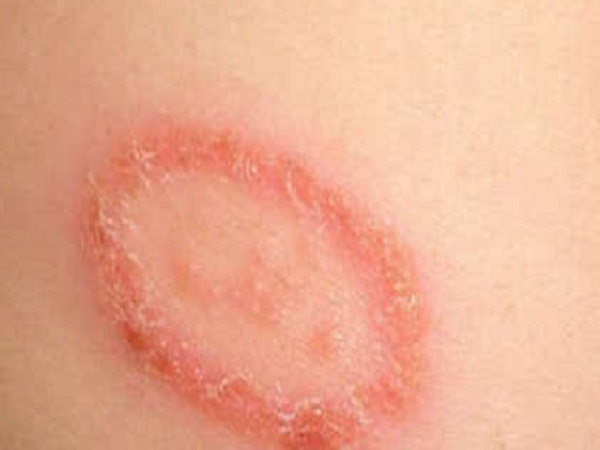 കൈത്തണ്ടയിലെ ചുവന്ന കുരുക്കള് കൈത്തണ്ടയിലെ ചുവന്ന കുരുക്കള്