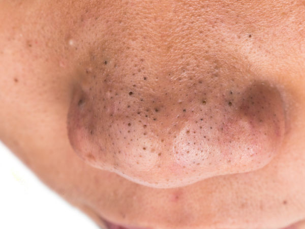 ബ്ലാക്ക്ഹെഡ്സ് കളയാൻ