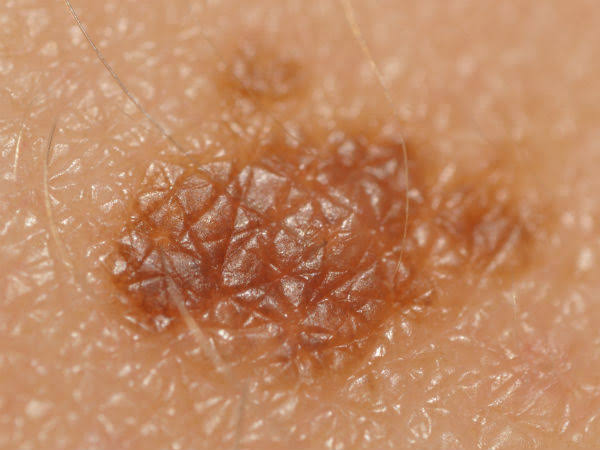  പെട്ടെന്നുണ്ടാവുന്ന മറുകിന്‍റെ കാരണങ്ങൾ