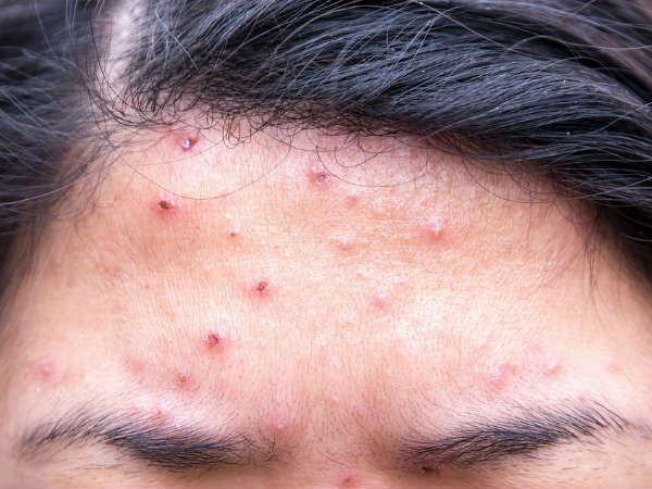 മുഖക്കുരു