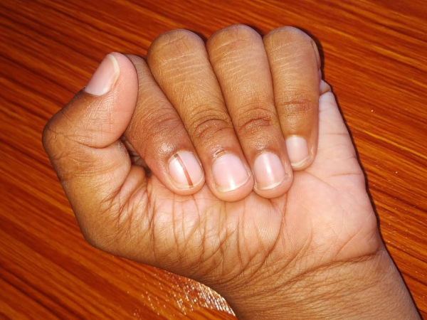 നഖത്തിലെ വരകള്‍