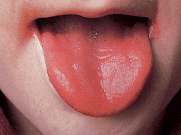 ചുവന്ന നാവ്