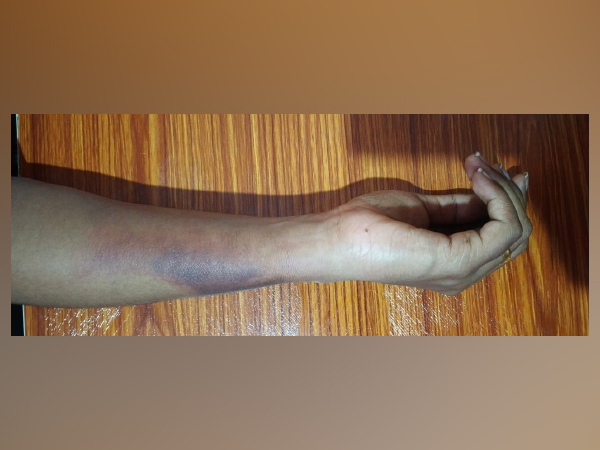 ഏത് തരത്തിലുള്ള പൊള്ളല്‍