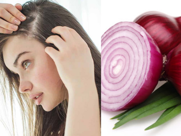 മുടി കൊഴിച്ചില്‍ തടയാന്‍ ഉള്ളി ജ്യൂസ്