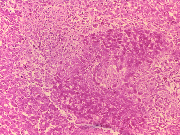 എന്താണ് ബ്രൂസെല്ലോസിസ്