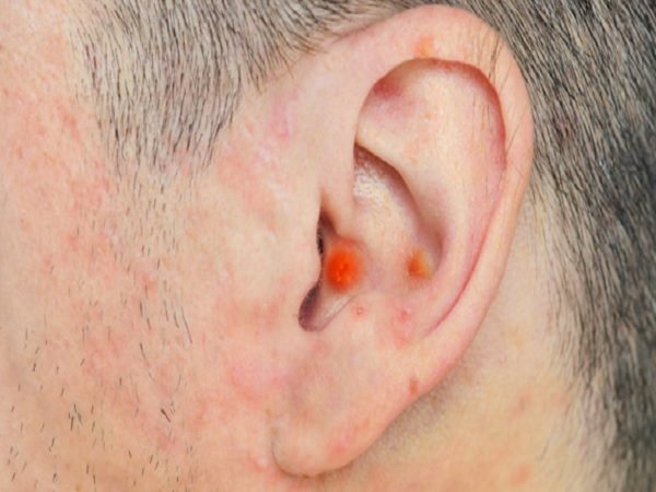 ചെവിയിലെ കുരുവിന് കാരണം