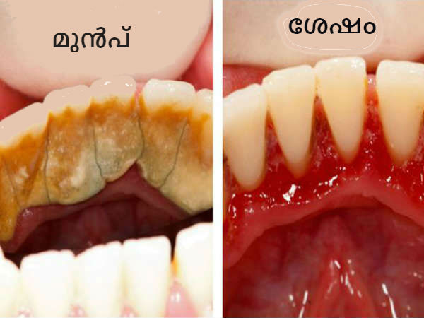 ടാര്‍ട്ടാര്‍ ഉണ്ടാവുന്നത് എങ്ങനെ തടയാം