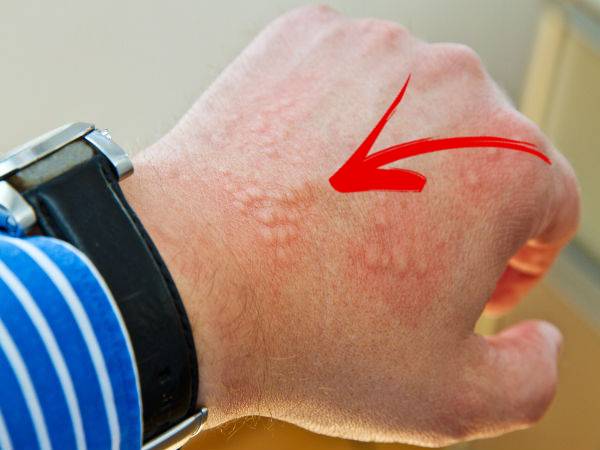 സ്‌കിന്‍ കാന്‍സര്‍ സാധ്യത കുറയ്ക്കുന്നു