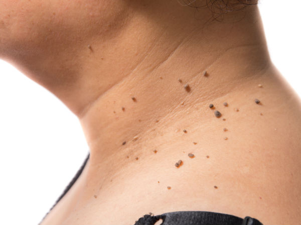 സ്വയം നീക്കം ചെയ്യുന്നത്