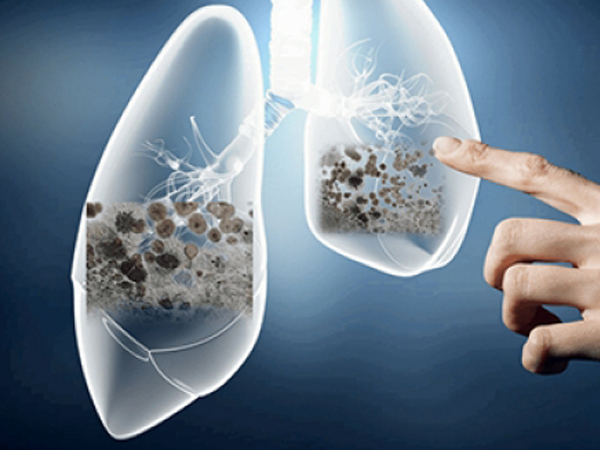 കൊവിഡും ന്യുമോണിയയും തമ്മിലുള്ള ബന്ധം