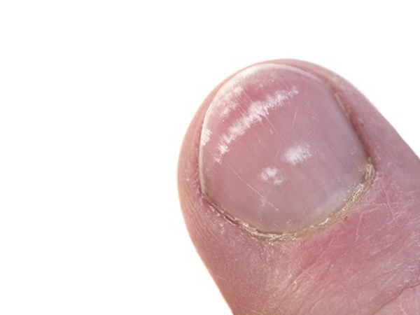 നഖത്തിലെ വെളുത്ത പാട് നിങ്ങളോട് പറയുന്നത്‌