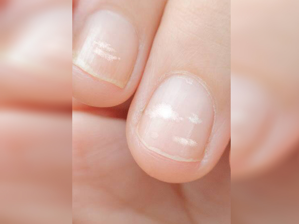 നഖത്തിലെ വെളുത്ത പാട് നിങ്ങളോട് പറയുന്നത്‌