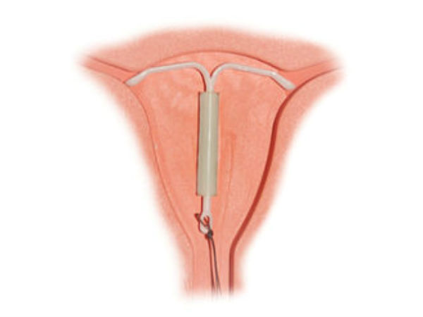 കോപ്പര്‍ ടി (IUD)