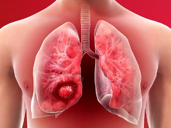 COPD രോഗനിര്‍ണയം