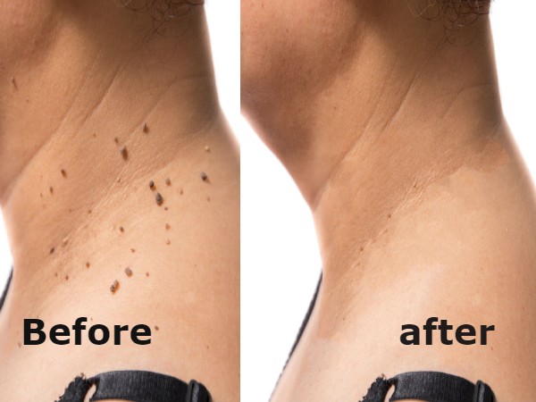 Tips For Healing Warts More Quickly Tips For Healing Warts More Quickly