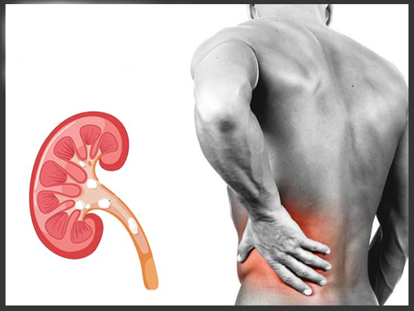 അഞ്ചാം ഘട്ട കിഡ്‌നി രോഗം