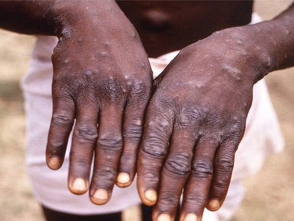 വസൂരിയുമായി സാമ്യമുള്ള ലക്ഷണങ്ങള്‍