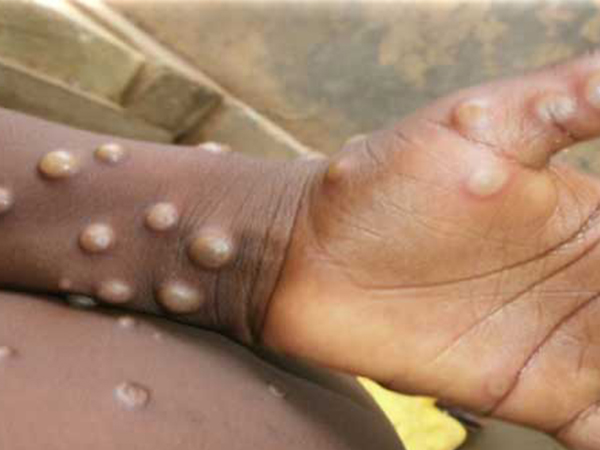 മങ്കിപോക്‌സിന്റെ വകഭേദങ്ങള്‍