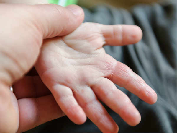 എക്സിമയുടെ ലക്ഷണങ്ങള് എക്സിമയുടെ ലക്ഷണങ്ങള്