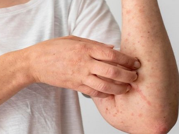 മങ്കിപോക്‌സിന്റെ ലക്ഷണങ്ങള്‍