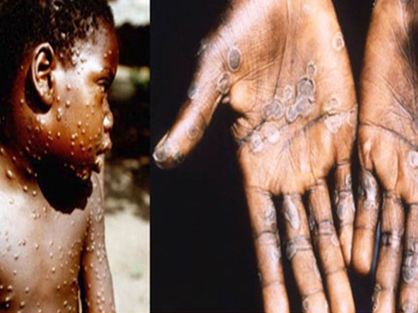  രോഗം പകരുന്ന വിധം