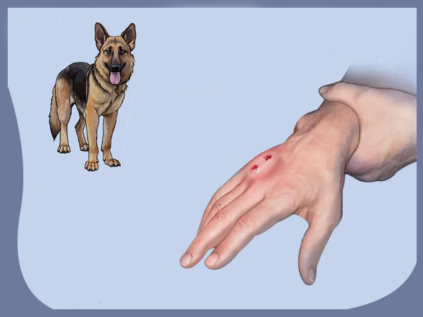 നായ കടിയേറ്റാലുള്ള പ്രഥമ ശുശ്രൂഷ