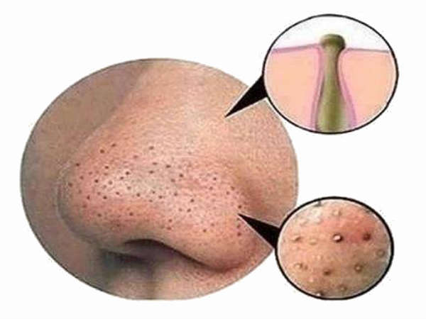 ഒമേഗ -3 ഫാറ്റി ആസിഡുകള്‍ 