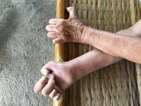 ജനുവരി 30 - ലോക കുഷ്ഠരോഗ ദിനം