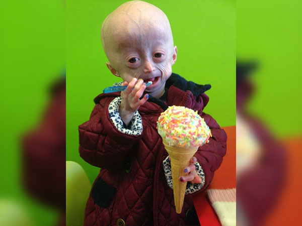 വെര്‍ണേഴ്‌സ് സിന്‍ഡ്രോം