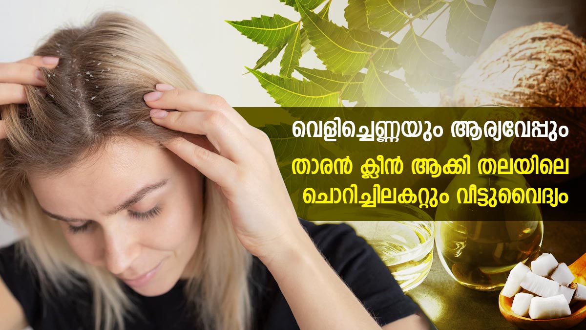 Home Remedies For Dandruff Home Remedies For Dandruff