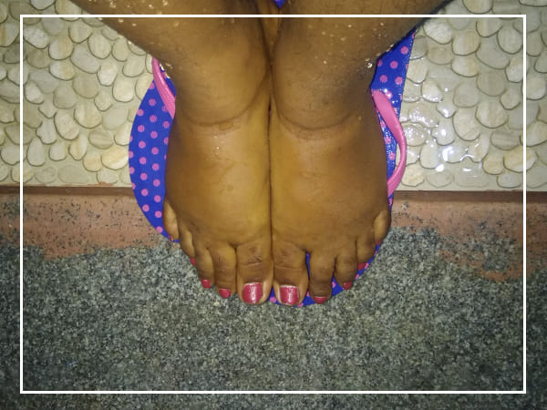 യൂറിക് ആസിഡ് കാരണങ്ങള്‍