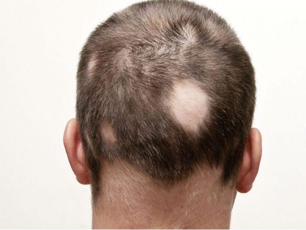 എന്താണ് അലോപ്പീസിയ ഏരിയറ്റ