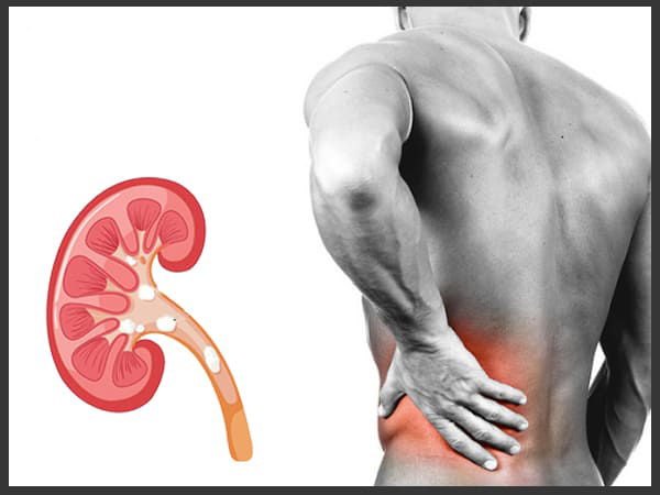 കിഡ്‌നി സ്റ്റോണ്‍ പരിഹരിക്കാം