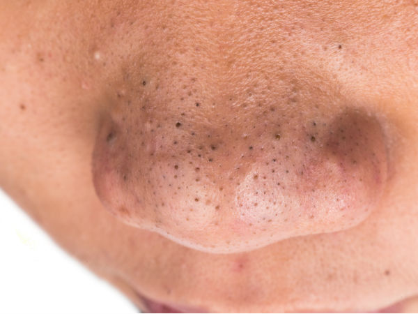 Use Turmeric In These Ways To Remove Blackheads; Details In Malayalam