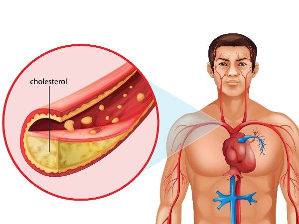 These Drink Will Help You To Lower Cholesterol Level In Summer Season; Details Inside 