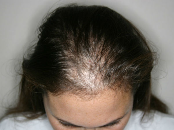 hair loss hair loss