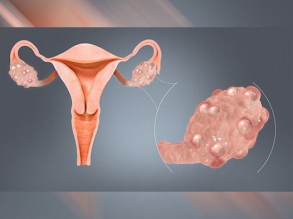 Chia Seed To Pumpkin Seed; Include These Five Seeds In Your Diet To Get Relief From PCOS Problem