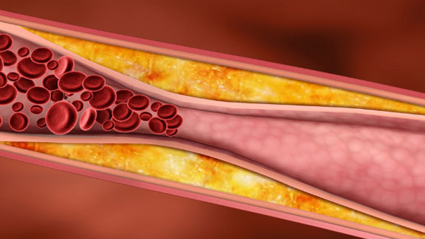cholesterol result